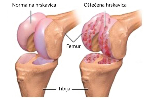artroza kolena gonartroza